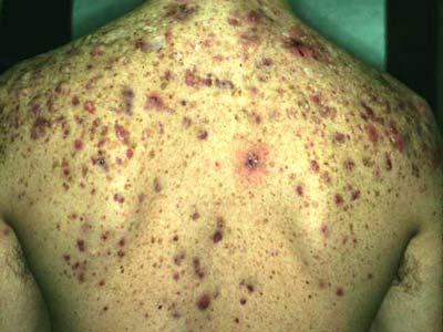 backne-acne-on-back.jpg
